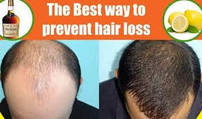 Coconut oil is an amazing ingredient that has many benefits to improve the health and condition of your hair. Why Is Coconut Oil The Best Natural Solution For Hair Loss Igraft