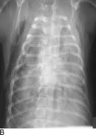 Image result for Pulmonary Contusion