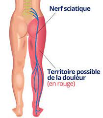 Le nerf sciatique est le nerf le plus long du corps et se situe derrière chacune des deux jambes. Douleur Sciatique Et Osteopathie Osteopathe Paris Mathilde Locqueville