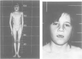 General view (left) andcfacies (riglt) (f the probaitd at 71½2 years.