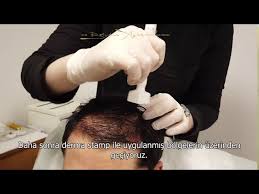 Igf Sac Tedavisi Derma Stamp Ile Nasil Uygulanir I Bilgehan Aydin Sac Ekim Merkezi Youtube