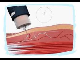 Injectie Insulina In Diferite Locuri Youtube
