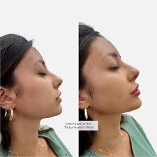 Lips, chin, and jaw combo 😍 with enhancing the chin and jaw, the face  definitely looks more proportioned. The changes are subtle but so  beautiful. We like to enhance your features, not