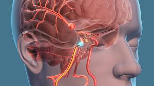 Every year, hundreds of patients with even the most complex brain aneurysms experience our collaborative approach, decades of experience and access to the full range of modern technologies, delivered with care and compassion. 3 Ways To Stop Brain Aneurysms From Leaking Or Bursting Health Essentials From Cleveland Clinic