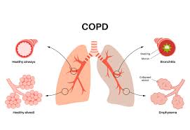 Image result for COPD Management