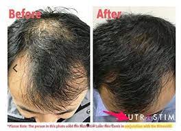 Hair loss treatments for women vary in price based on the formula and the size of the bottle. The 4 Best Laser Combs For Hair Growth 2021 Reviews Hair Laser Growth Laser Hair Comb Clear Hair
