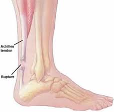 With aging and overuse, the achilles tendon is subject to degeneration within the substance of the tendon. Plantar Fasciitis Braces In Yuen Long San Hui Hksar Plantar Fasciitis Pain Management Hong Kong