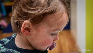 Image result for Measles