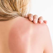 Sonnenbrand Behandeln Tipps Und Tricks Gala De
