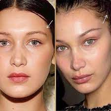 Maybe you would like to learn more about one of these? 10 Thread Lift Before After Pictures Eyebrow Lift Thread Lift Thread Lift Face