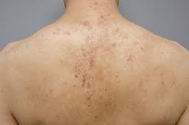 Image result for Keratosis pilaris
