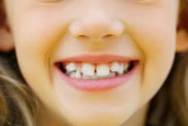 Dientes Chuecos Causas Y Puntos A Tomar En Cuenta