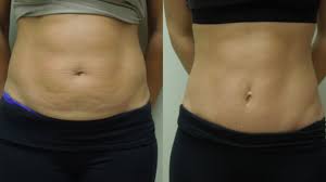 Maybe you would like to learn more about one of these? Mini Tummy Tuck Cost Procedure And More
