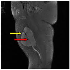 Image result for Leiomyosarcoma