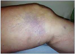 How To Manage Complications After Sclerotherapy Servier Phlebolymphologyservier Phlebolymphology
