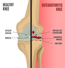 Pin On Arthritis