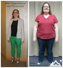 Pin On Free Gastric Bypass