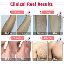 I have been waxing for 8 months now and i 100% recommend it! Laser Hair Removal For Women Men Imene 500 000 Flashes Ipl Permanent Hair Removal Upgrade Ice Compress Home Use Hair Remover On Bikini Line Legs Arms Armpits More Safe And Comfortable