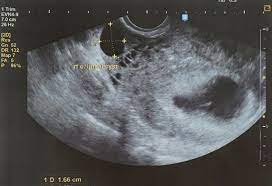 What does my baby look like? 5 Weeks Pregnanct Ultrasound Procedure Abnormalities And More