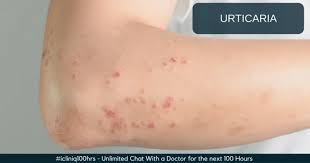Image result for Papular urticaria