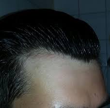Histogen's hair stimulating complex (hsc) platelet rich plasma therapy (prp) replicel. M 23 Receding Hairline Page 5 Baldtruthtalk Com