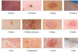Occasionally they become thrombosed and may fall off or persist as a firm bluish papule. Pin On Skin Hair Nails