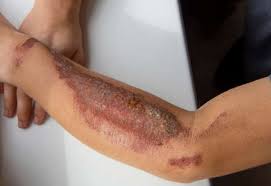 Image result for Rhus Dermatitis