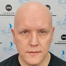 Scalp Micropigmenation Boston| Clients