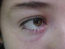 El Orzuelo Y El Chalacion Ocularis
