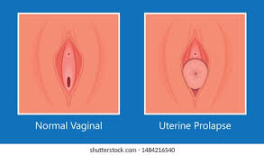 Image result for Urethral Prolapse