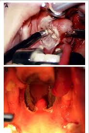 Image result for Tonsillectomy