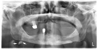 Image result for Sialolithiasis