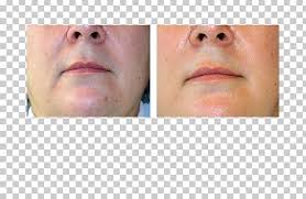 Thankfully, the lasers used on me had a cooling mechanism (basically a. Lip Fotoepilazione Intense Pulsed Light Laser Hair Removal Png Clipart Cheek Chin Closeup Electrolysis Eyebrow Free