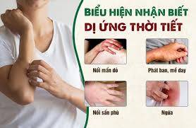 Dị ứng thời tiết: Nỗi ám ảnh của nhiều người là bệnh gì? – Bệnh Viện An Việt