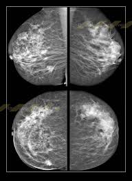 Radiology Archives Blabh Mastoy Bi Rads 5