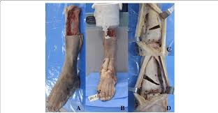 Peroneal tendonitis affects these tendons, and can make movement difficult and painful. A Lower Leg Preserved Syndesmotic Structure And Tendon Ligament B Download Scientific Diagram