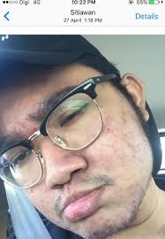 Pelbagai cara yang boleh dilakukan untuk menghilangkan parut jerawat antaranya adalah menggunakan serum hilangkan parut jerawat. Pemuda Ini Kongsi Step By Step Nak Hilangkan Jerawat Fesyen Tips Penjagaan Diri Wanita Lelaki Forum Cari Infonet