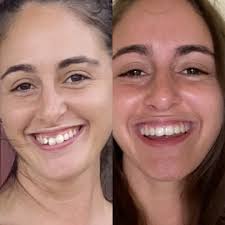 👉👉GET CLEAR ALIGNERS FOR 🦷🦷 👉👉O N L Y 😍$ 3 4 9 5!😍 ✓✓💲💲👈👈 To  Know More: 📅Schedule your Consultation, 📲Call the office today  480.614.1122 #MyScottsdaleDentist #dental #brushdaily #review  #smilesfordays #dentist #