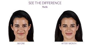 Juvederm Family Of Products Rejuvenessence Medispa