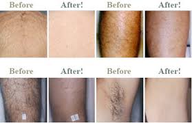 laser hair removal chicago orland park