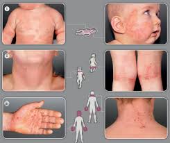 Image result for dermatitis contacta children