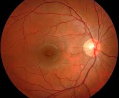 Histoplasmosis Louisville Ky Eye Surgery Florence