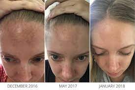 What makes it so magical? The Vitamin C Serum That Helped Reverse My Melasma A Short Engagement