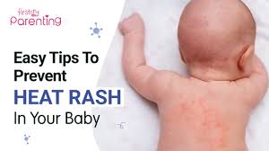 Image result for sweat rash on back baby