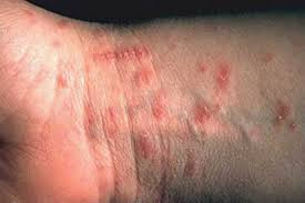 Image result for scabies norvegica