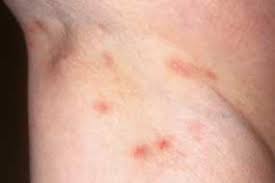 Image result for scabies human bites