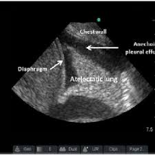 Pleural effusion symptoms include shortness of breath or trouble breathing, chest pain, cough, fever, or chills. Complex Septated Pleural Effusion Download Scientific Diagram