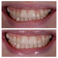 How to treat cavities naturally | dr. How To Fix A Chipped Tooth Repair Treatment Guide