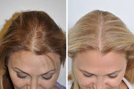 Si cette perte de cheveux dure moins de 6 mois on parle d 'une perte de cheveux aiguë. Profil Rattraper Adieu Perte Densite Cheveux Femme Capbretontriathlon Com