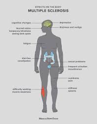 There is no cure for ms, but treatments are available to slow the progression of the disease and manage symptoms. 15 Symptoms Of Multiple Sclerosis Ms In Women